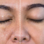 الاثار الجانبية للميزوثيرابي