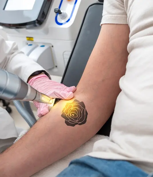 laser tattoo removal 2