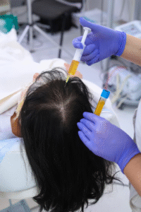 تحفيز نمو الشعر بالبلازما PRP