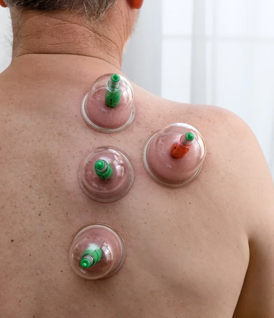 therapeutic cupping 2