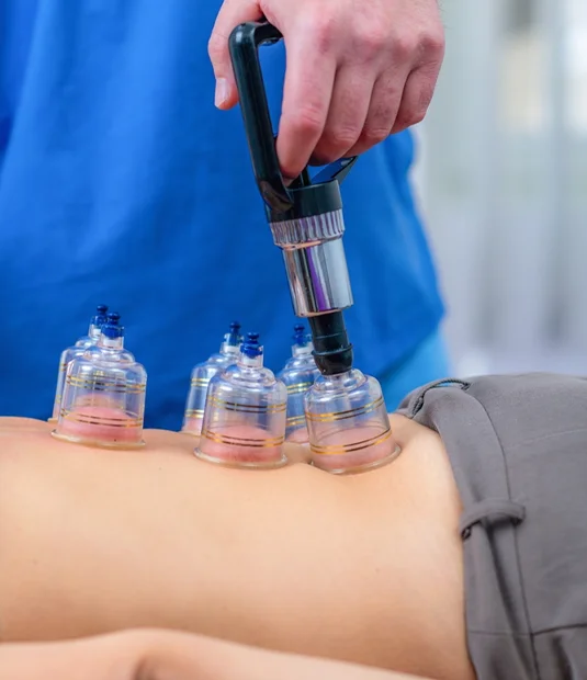therapeutic cupping