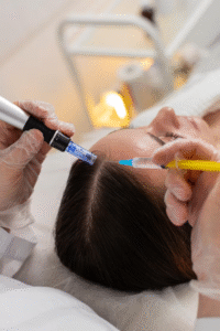 تحفيز نمو الشعر بالبلازما PRP