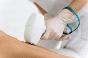 أسعار إزالة الشعر بالليزر للنساء